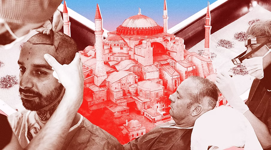 Hair Transplant Story